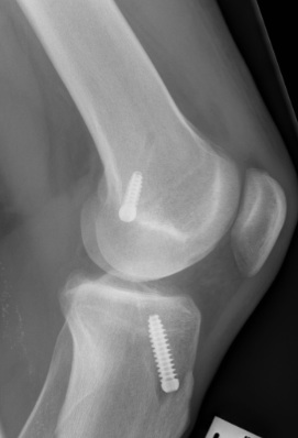 ACL Hamstring 2 x RCI Screws Lateral